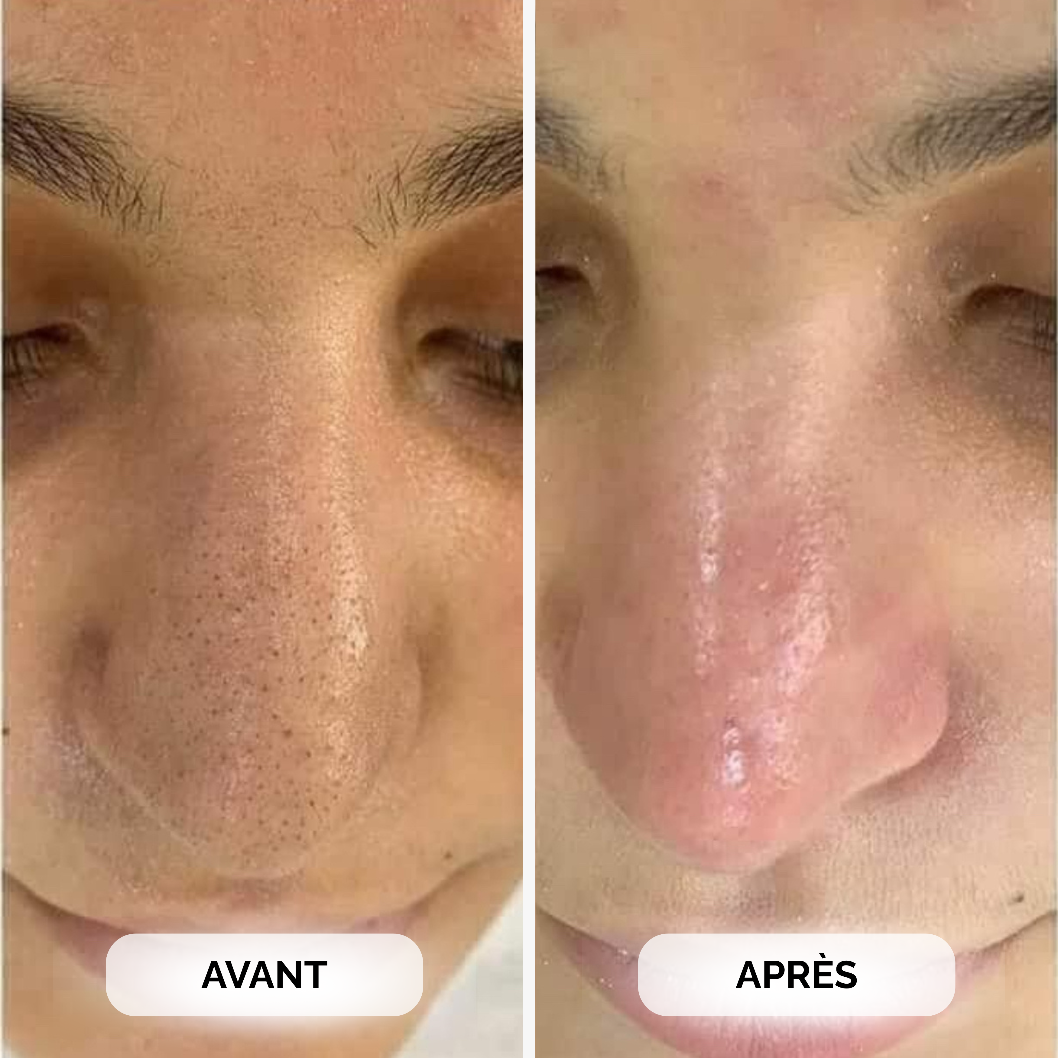 Avant / après acné et rougeurs