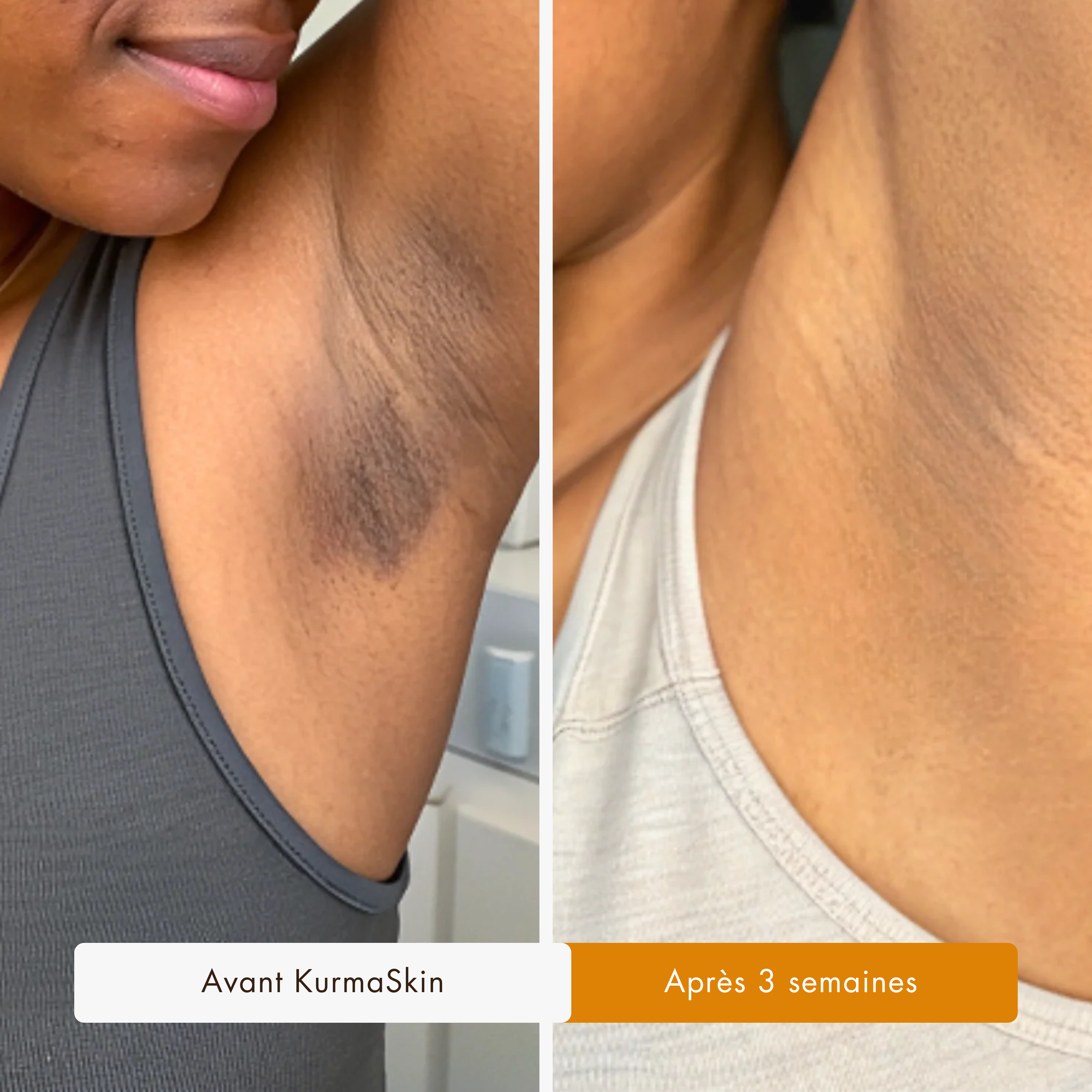 Avant / après taches visage