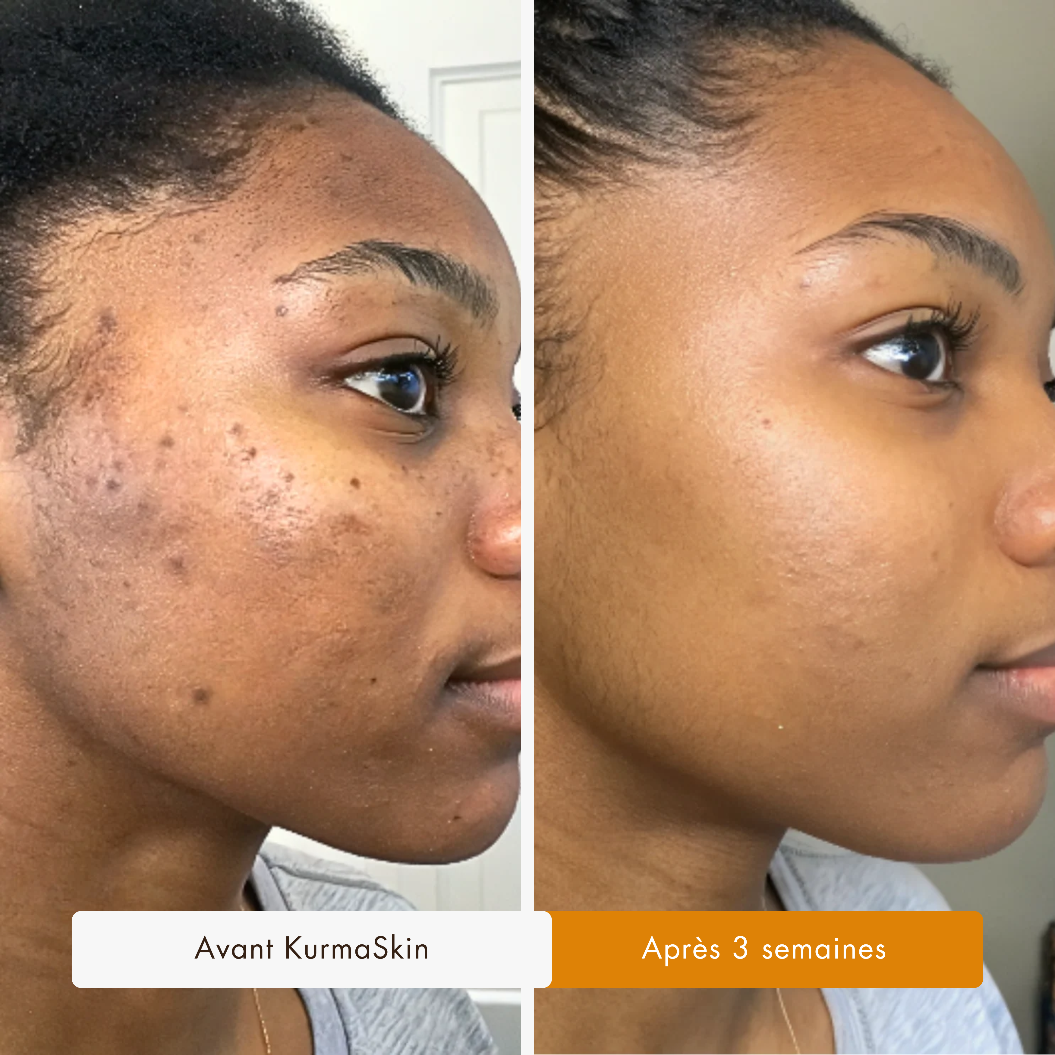 Avant / après taches pigmentaires