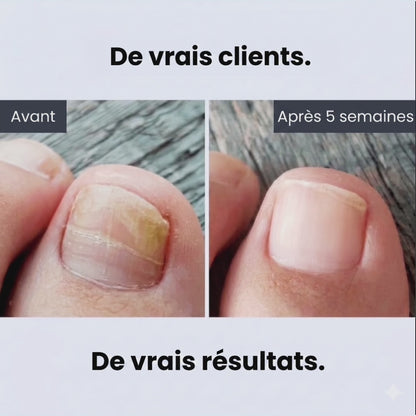 Éliminez la mycose des ongles à la racine — et pas seulement en surface.